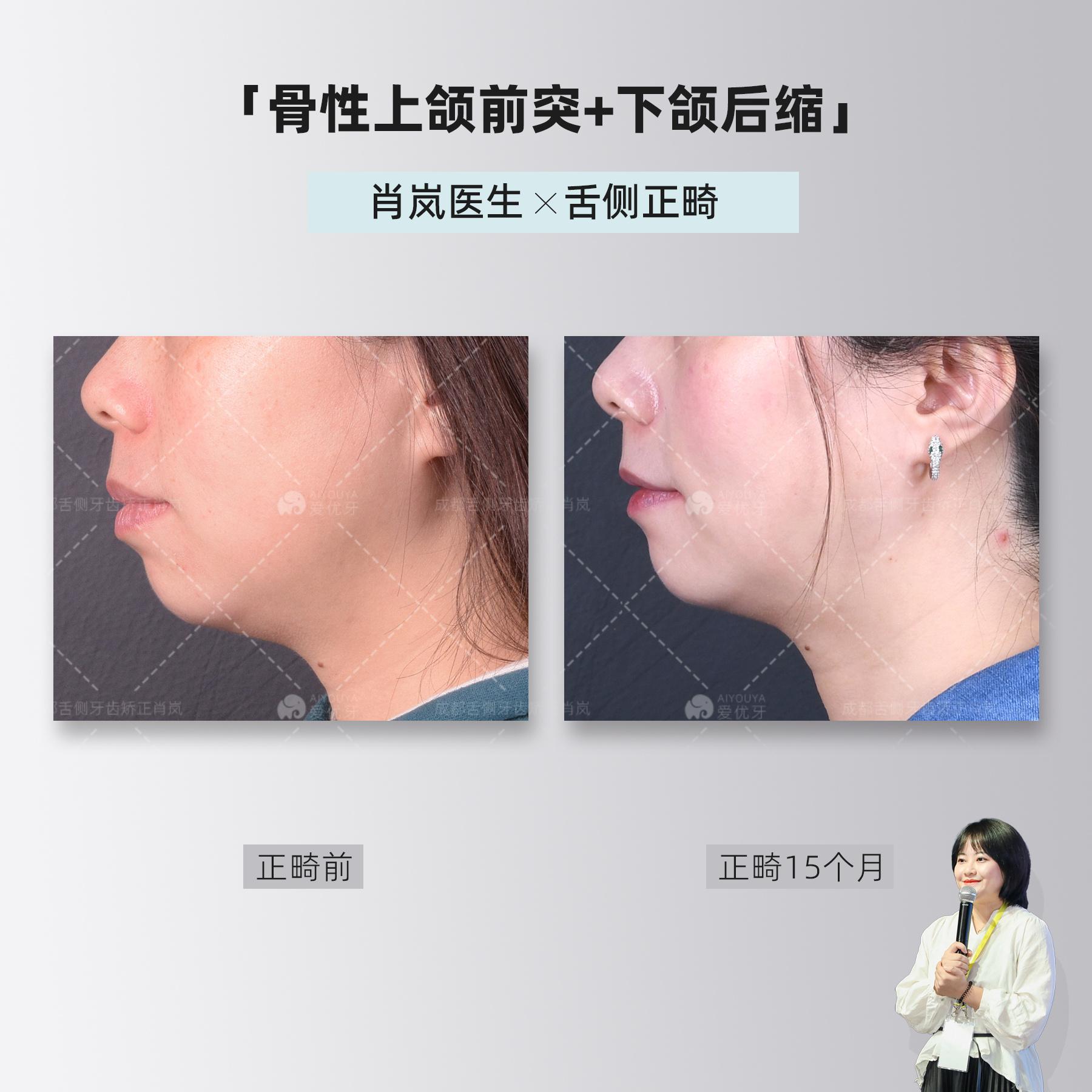 下巴颏(下巴颏肿了有硬块疼怎么回事) 下巴颏(下巴颏肿了有硬块疼怎么回事)