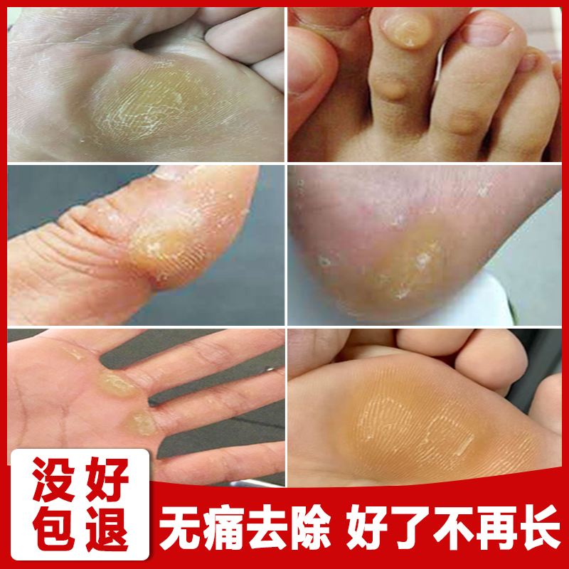 胼胝的拼音(胼胝的拼音和意思) 胼胝的拼音(胼胝的拼音和意思)