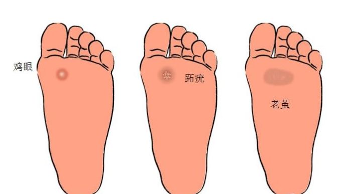 胼胝怎么读(手足胼胝怎么读)